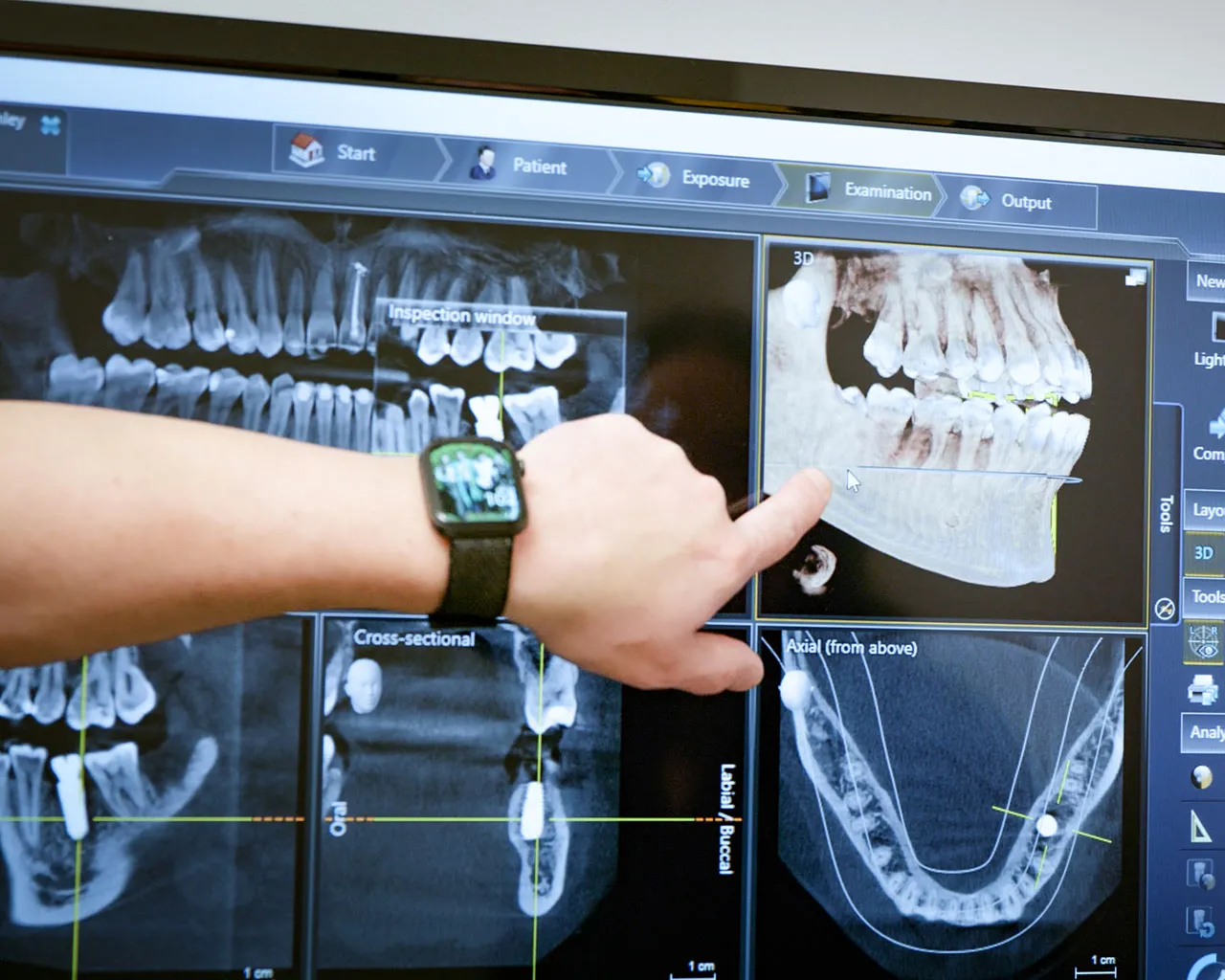 Tooth Extraction Dentists Metro Detroit