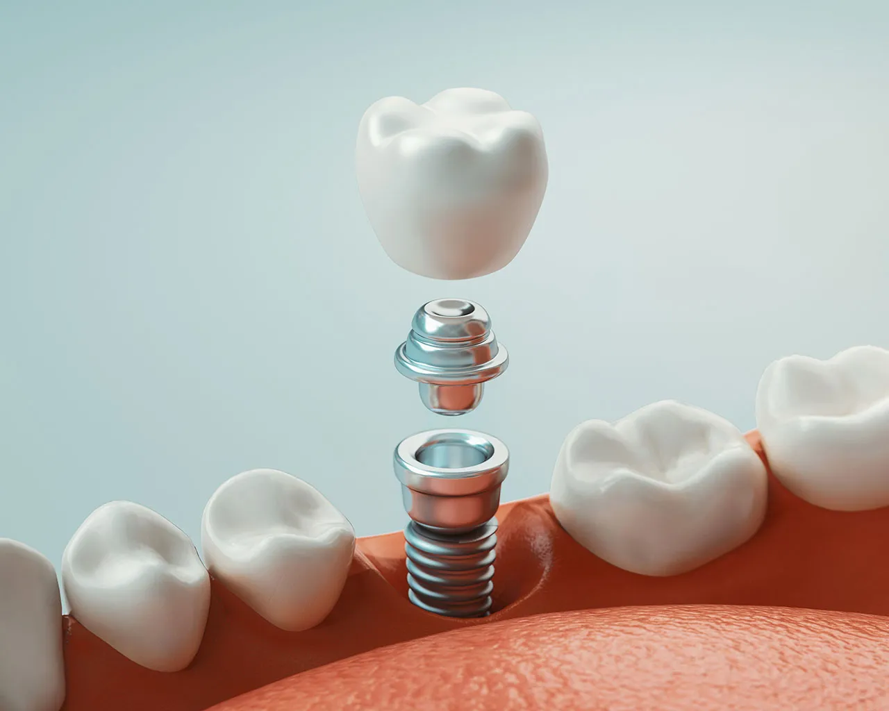 Dental Implant Dentists Near Me