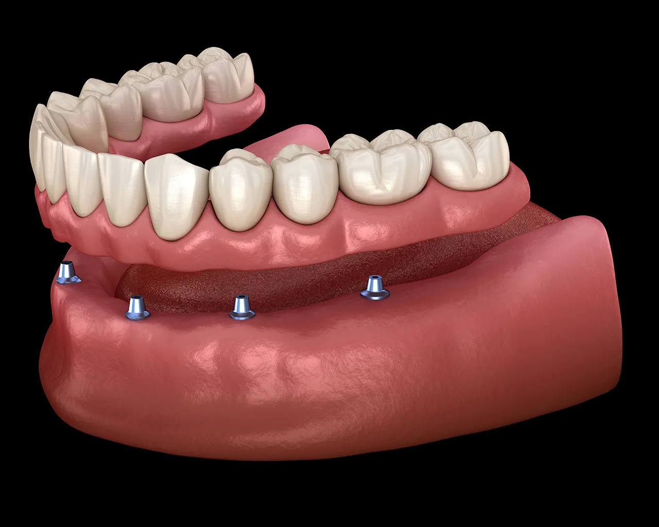 Metro Detroit All-on-X Dental Implant Dentists