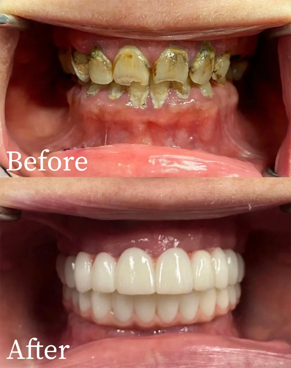Macomb Township And Shelby Township All On X Implant Dentists