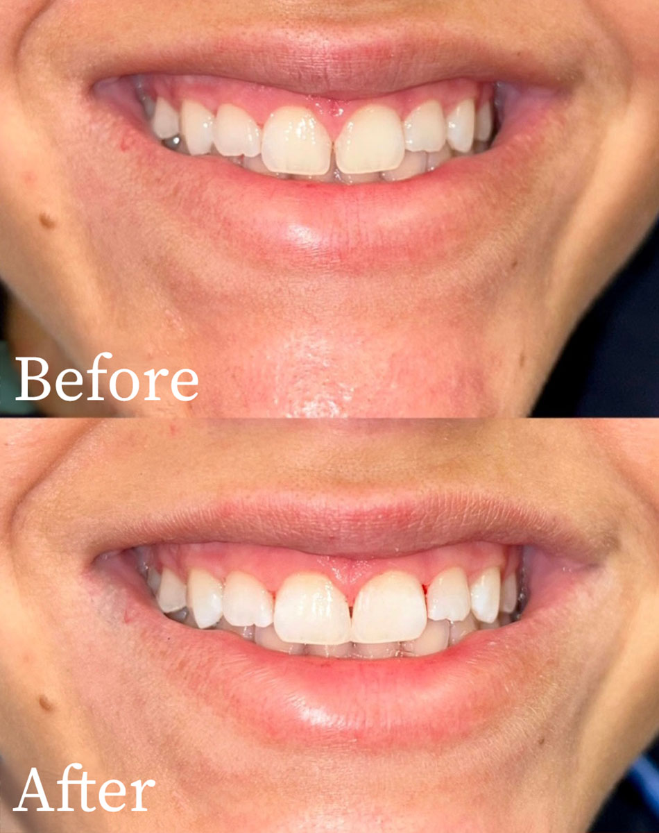 Macomb Township And Shelby Township Clear Aligner Dentists
