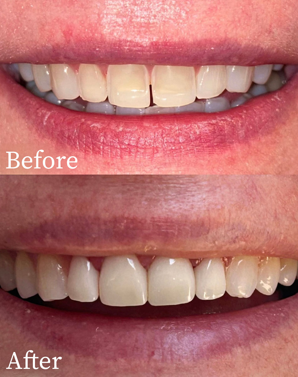 Macomb Township And Shelby Township Porcelain Veneer Dentists