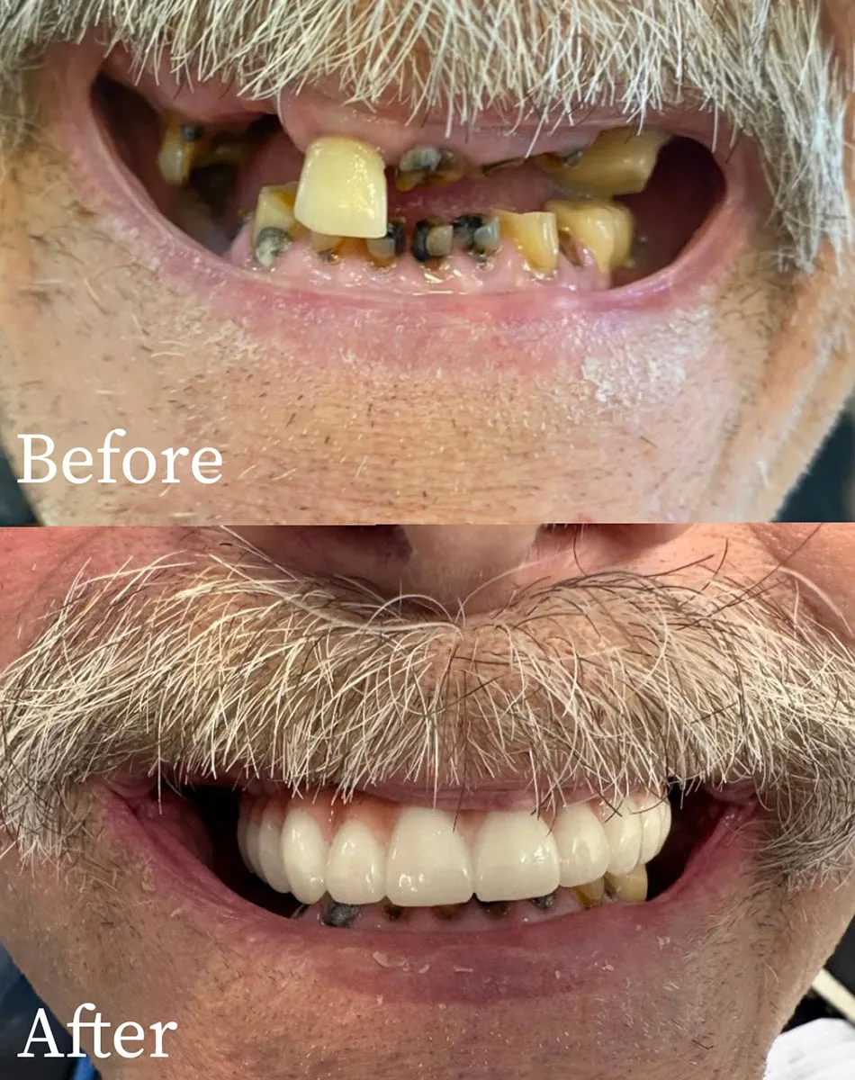 Denture Dentist Macomb And Shelby Townships